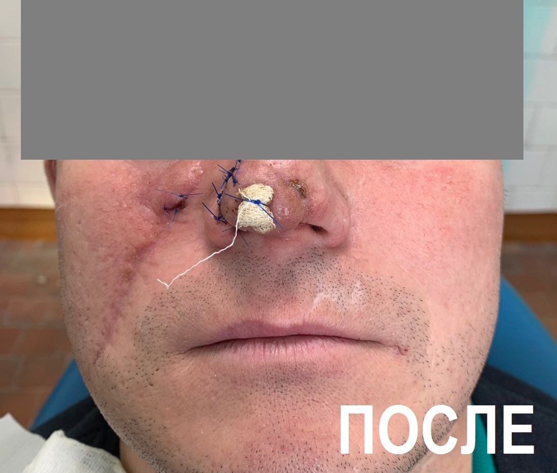 В Республиканской больнице улан-удэнцу восстановили откушенный нос ФОТО 18+