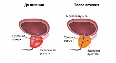 Инсульт или не инсульт? Врачи Республиканской больницы поставили правильный диагноз мужчине с аденомой простаты