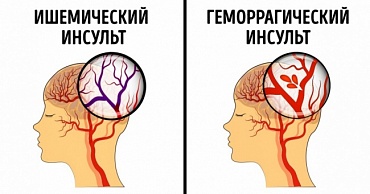 Инновации в постинсультной реабилитации. Конференция 6 апреля в Республиканской больнице