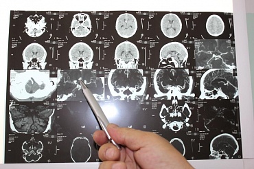 История спасения: в Республиканской больнице проведена эндоваскулярная эмболизация мешотчатой аневризмы головного мозга пациенту с синдромом слабости синусового узла
